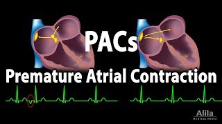 Premature Atrial Contractions PACs Animation [upl. by Narat]