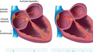 Valvulas y tonos cardiacos cardiopatias valvulares y congénitas [upl. by Yecrad]