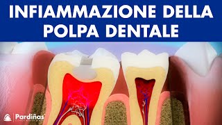 Pulpite  Infiammazione della polpa dentale © [upl. by Affer]