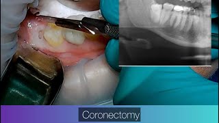 Coronectomy of a Wisdom Tooth drwahan [upl. by Myca]