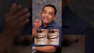 അര മണിക്കൂറിൽ പല്ല് ശെരിയാക്കാം dentalclinic dentaltips dentalcrowns dentalveneers smile [upl. by Beberg719]