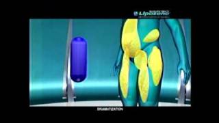 LIPOZENE REMIX VIDEO [upl. by Manouch530]