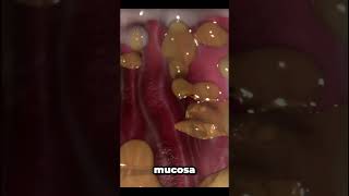 helicobacter pylori infection [upl. by Beghtol539]