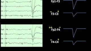 Eye Movements on EEG [upl. by Yrotciv741]