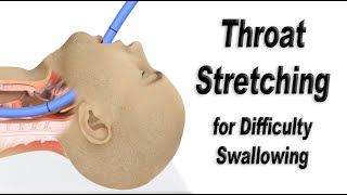 Esophageal Dilation or Throat Stretching for Difficulty Swallowing [upl. by Schuman456]