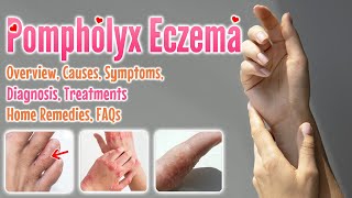 Pompholyx eczema causes symptoms diagnosis treatment home remedies FAQ  Dyshidrotic eczema [upl. by Gentes]