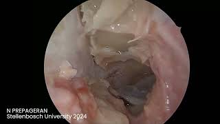 Module 4 Orbital Optic Nerve Decompression Intraconal Dissection [upl. by Gaylene]