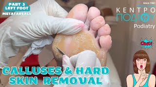 Part 3 Calluses amp Hard Skin Removal feet κεντροποδιου foot podologos podiatrist corn footcare [upl. by Nance609]