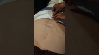 back pain dry needling [upl. by Sordnaxela]