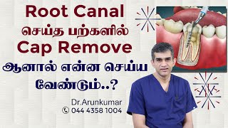 Root Canal Tooth Turning Black  Cap Fell Off After Root Canal  Pearls DentistryDrArunkumar [upl. by Peonir]