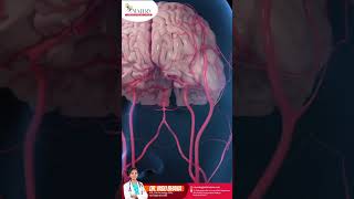 Bhain stroke and types of brain stroke  Neurologist indore  DrIndu Bhana [upl. by Yllek]