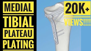 Medial Approach and Plating of Medial Tibial Condyle [upl. by Annodas953]