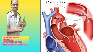 COARCTATION OF THE AORTA BY DRSUMIT TYAGISUMITMEDICALDISPENSARY1 [upl. by Namie]