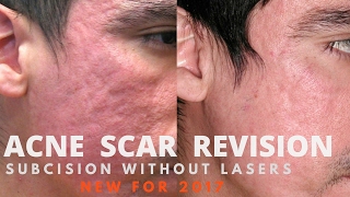 Microneedling Procedure at VCare  Best Treatment For Acne Acne Scars Wrinkles amp Fine Lines [upl. by Recor]