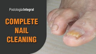 Complete nail cleaning Podología Integral Integral Podology [upl. by Shifra]