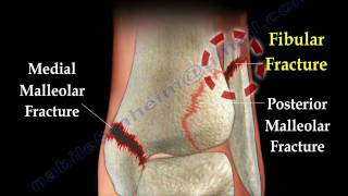 Ankle fracture  Fractures and its repair Everything You Need To Know  Dr Nabil Ebraheim [upl. by Garling]