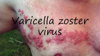 How to Pronounce Varicella zoster virus [upl. by Ajup751]