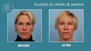 Sculptra filler for cheeks and jawline [upl. by Toomay]