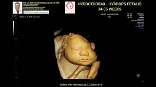 Hydrothorax  Hydrops fetalis 3435 weeks [upl. by Ronda]