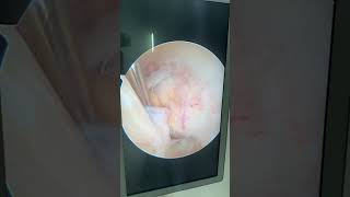 ACL ganglion cystkeyhole surgery arthroscopic decompression kneearthroscopy acl ganglioncyst [upl. by Anitreb]