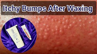 Rashes After Waxing  How To Get Rid Of Itching amp Small Bumps After Wax [upl. by Yrol]