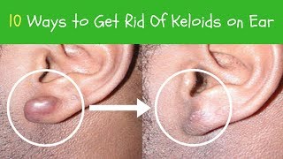 10 Ways to Get Rid Of Keloids on Ear  keloid Scar Removal [upl. by Falito]