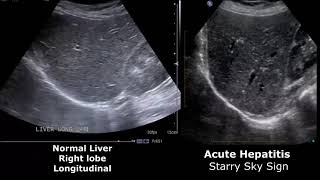 Liver Ultrasound Normal Vs Abnormal Image Appearances Comparison  Liver Ultrasound Pathologies [upl. by Joshua]