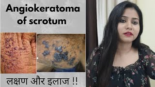 Angiokeratoma of fordyceScrotum homeopathic treatment  Angiokeratoma symptomscauses amp medicine [upl. by Iggep]