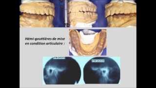 OrthodontieOcclusodontieFin de traitement version intégrale [upl. by Imrots389]