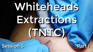 Whiteheads Extraction TNTC  Session 5 Part I [upl. by Savinirs]