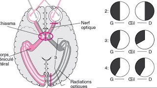 🔺Champ viseul  voies optiques  lésions optiques [upl. by Redep149]