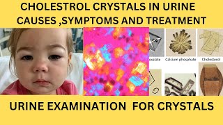 CHOLESTROL CRYSTAL IN URINECAUSES SYMPTOMS AND TREATMENT OF CHOLESTROL CRYSTALS URINARY CRYSTAL [upl. by Burgwell]