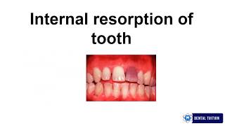 Internal Resorption  Conservative and Endodontics Exam notes [upl. by Sirad522]