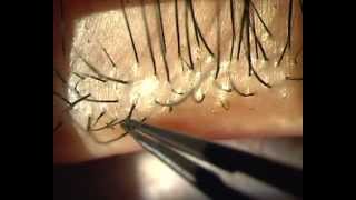 Demodex Blepharitis  Is it for real [upl. by Aniaj]