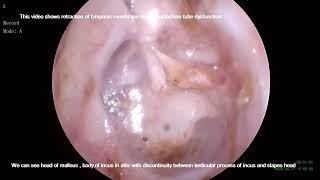 Grade IV Tympanic membrane retraction [upl. by Nelram]