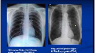 Chest xray interpretation COPD and Emphysema [upl. by Cyprio837]