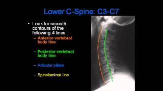 Radiology of Spine Trauma [upl. by Ytisahcal]