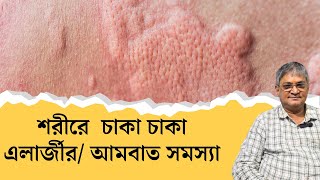 Hives  UrticariaCausesSymptomsTreatment in Bengali  এলার্জি থেকে মুক্তির উপায়  skin allergy [upl. by Andryc]