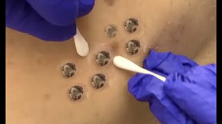 Extreme Blackhead Extraction From Back [upl. by Onairpic]