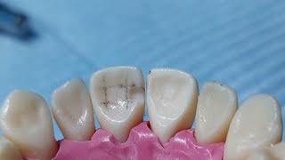 cavity preparation class III for Composite restorationDrghazal [upl. by Manya]