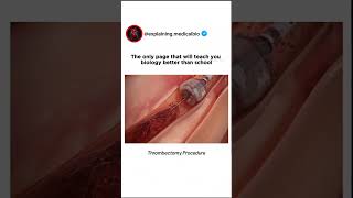 Thrombectomy procedure 🤯👨‍🔬 shorts medical science biology ytshorts thrombectomy ♡♡ [upl. by Arsi]