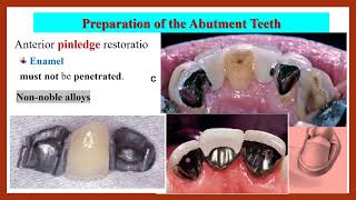 StepbyStep Preparation of Resinbonded FDP بالعربي [upl. by Annairdna848]