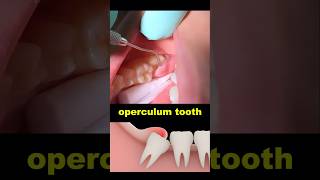 Operculum tooth treatment dentist dentistry wisdomtooth [upl. by Ttennaj]