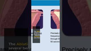 What causes Atrial Fibrillation medicine cardiology medical [upl. by Daile575]