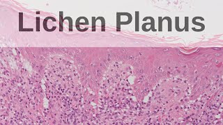 Lichen Planus  Pathology mini tutorial [upl. by Igenia]