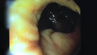 Video of a Colonoscopy [upl. by Zoa]