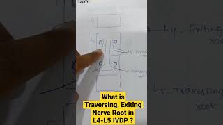 What is Traversing Exiting Nerve Root in L4L5 IVDP  Dr Sai Chandra MBBS DNB Ortho [upl. by Irik567]