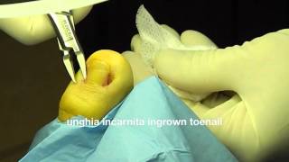 unghia incarnita  uña encarnada  ingrown toenail surgical treatment 向内生长趾甲 podologo [upl. by O'Conner]