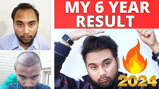 My Full Hair Transplant Result Journey Of 6 Years  How Hair Transplant Results Changed My Life 2024 [upl. by Hanyaz969]