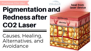 HOWS CO2 LASER WORKS [upl. by Dagley]